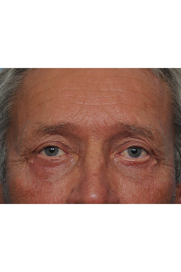 Eyelid Lift Before & After Gallery - Patient 8376666 - Image 4
