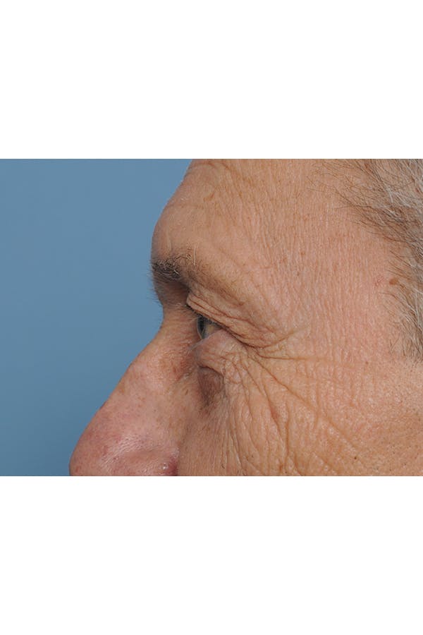 Eyelid Lift Before & After Gallery - Patient 8376666 - Image 5