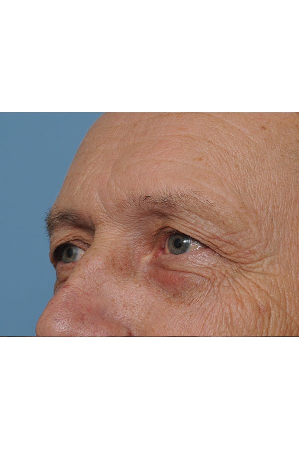 Eyelid Lift Before & After Gallery - Patient 8376666 - Image 7