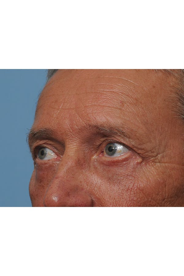 Eyelid Lift Before & After Gallery - Patient 8376666 - Image 8