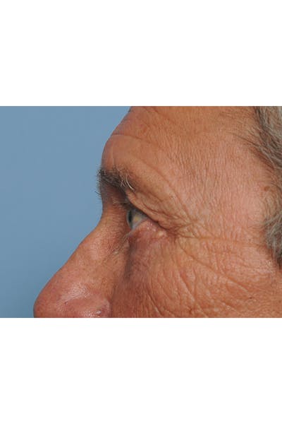 Eyelid Lift Before & After Gallery - Patient 8376666 - Image 6