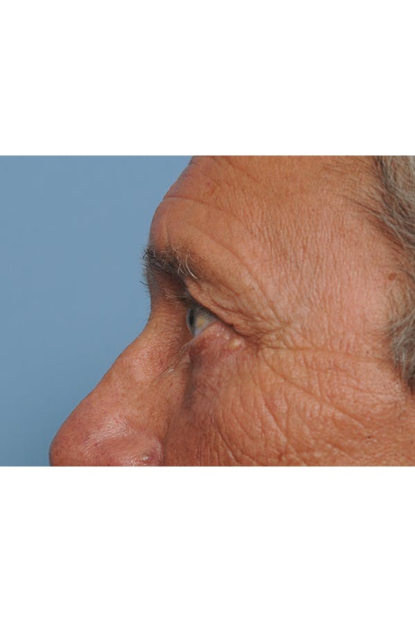 Eyelid Lift Before & After Gallery - Patient 8376666 - Image 6