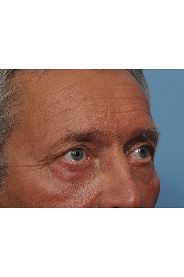 Eyelid Lift Before & After Gallery - Patient 8376666 - Image 12