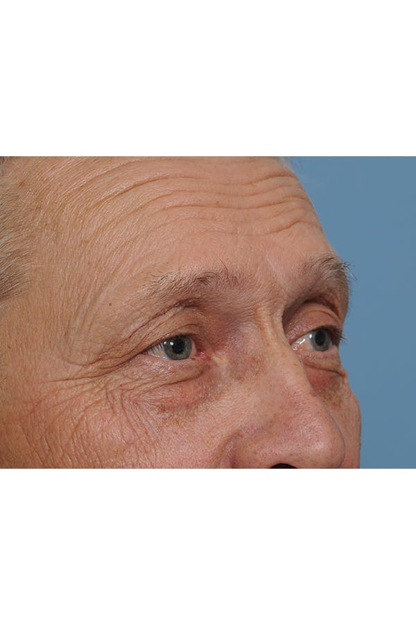 Eyelid Lift Before & After Gallery - Patient 8376666 - Image 11