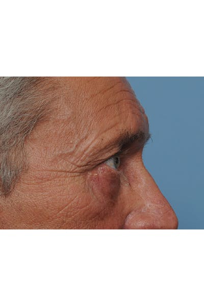 Eyelid Lift Before & After Gallery - Patient 8376666 - Image 10