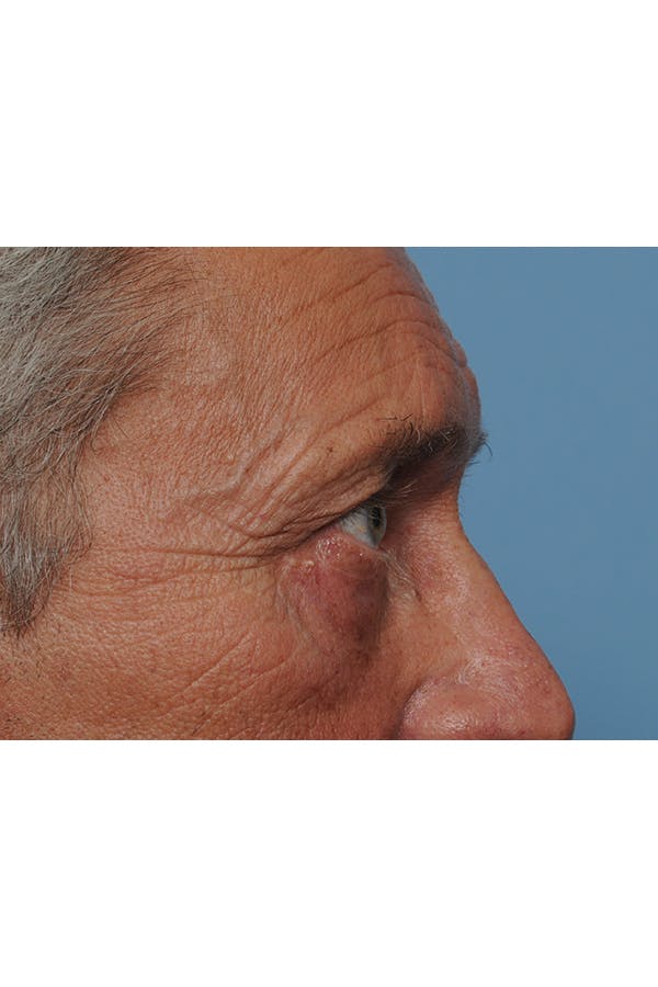 Eyelid Lift Before & After Gallery - Patient 8376666 - Image 10