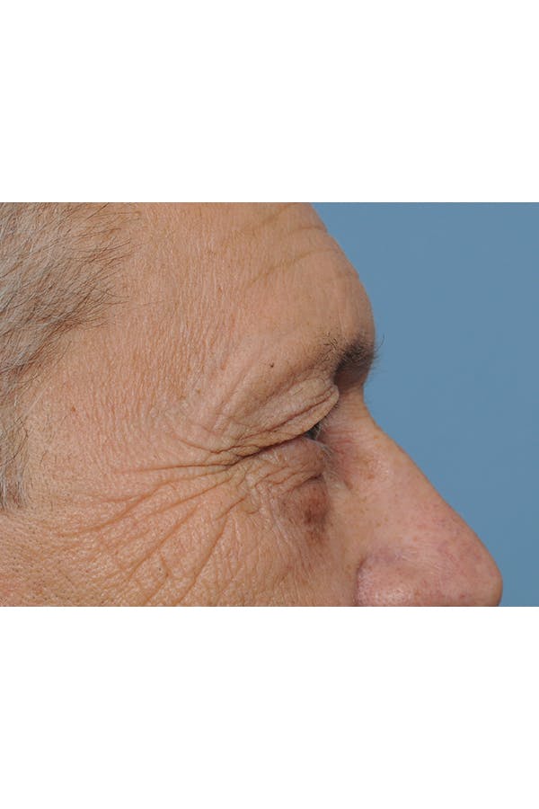 Eyelid Lift Before & After Gallery - Patient 8376666 - Image 9