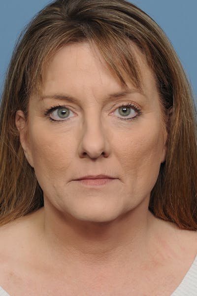 Rhinoplasty Before & After Gallery - Patient 8376738 - Image 1