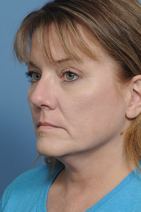 Rhinoplasty Before & After Gallery - Patient 8376738 - Image 6
