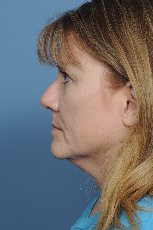 Rhinoplasty Before & After Gallery - Patient 8376738 - Image 2