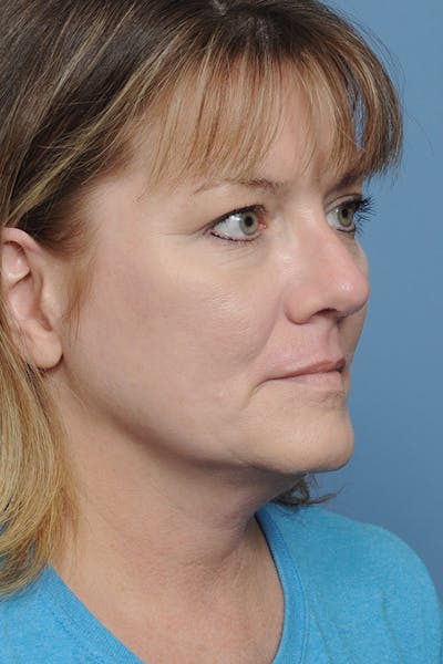 Rhinoplasty Before & After Gallery - Patient 8376738 - Image 10