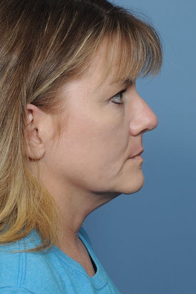 Rhinoplasty Before & After Gallery - Patient 8376738 - Image 8