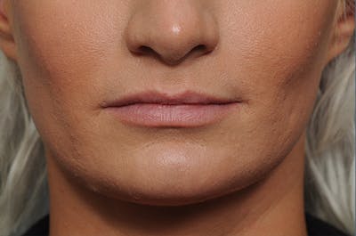 Jawline & Neck Filler Before & After Gallery - Patient 144976769 - Image 1