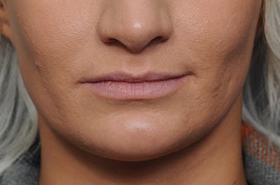 Filler Refinement Before & After Gallery - Patient 8615334 - Image 2