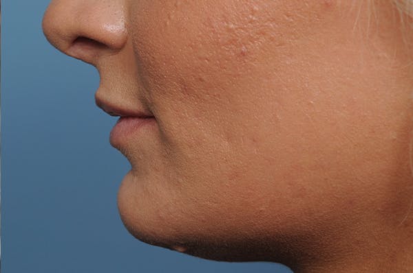 Jawline & Neck Filler Before & After Gallery - Patient 144976769 - Image 3