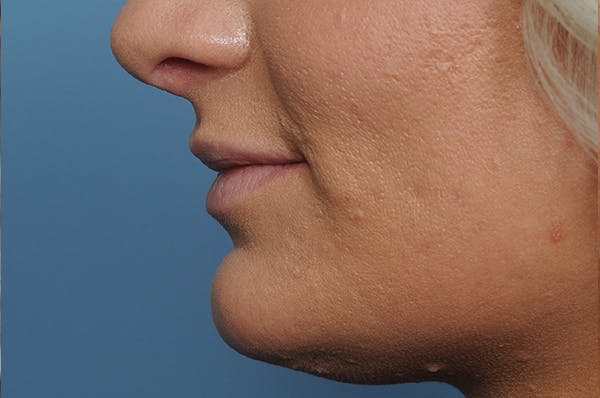 Jawline & Neck Filler Before & After Gallery - Patient 144976769 - Image 4