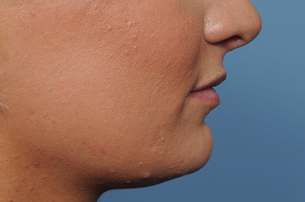 Jawline & Neck Filler Before & After Gallery - Patient 144976769 - Image 5