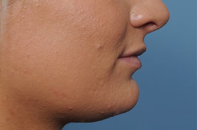 Jawline & Neck Filler Before & After Gallery - Patient 144976769 - Image 6