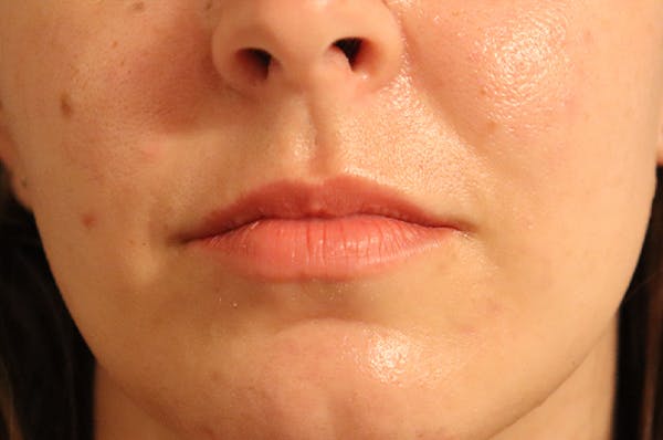 Lip Filler Before & After Gallery - Patient 144976771 - Image 1