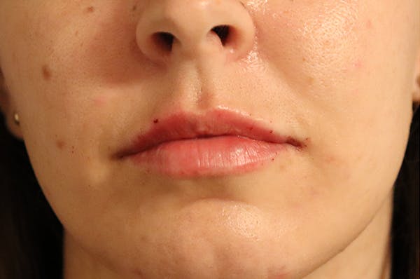 Lip Filler Before & After Gallery - Patient 144976771 - Image 2