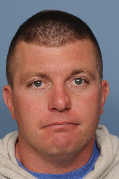 Mole Removal Before & After Gallery - Patient 8647153 - Image 1