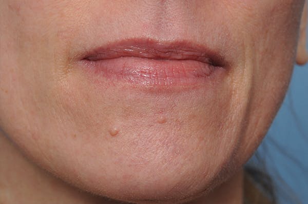 Mole Removal Before & After Gallery - Patient 8647154 - Image 1