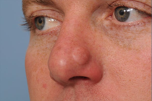 Mole Removal Before & After Gallery - Patient 8647153 - Image 3