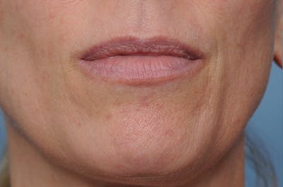 Mole Removal Before & After Gallery - Patient 8647154 - Image 2