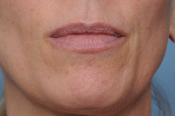 Mole Removal Before & After Gallery - Patient 8647154 - Image 2