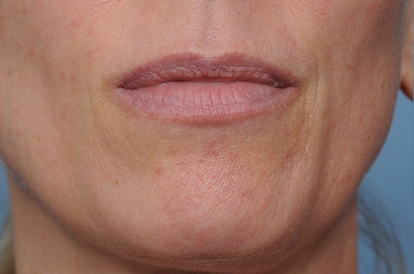 Blemish & Mole Removal