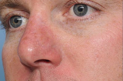 Mole Removal Before & After Gallery - Patient 8647153 - Image 4