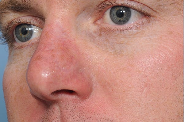 Mole Removal Before & After Gallery - Patient 8647153 - Image 4