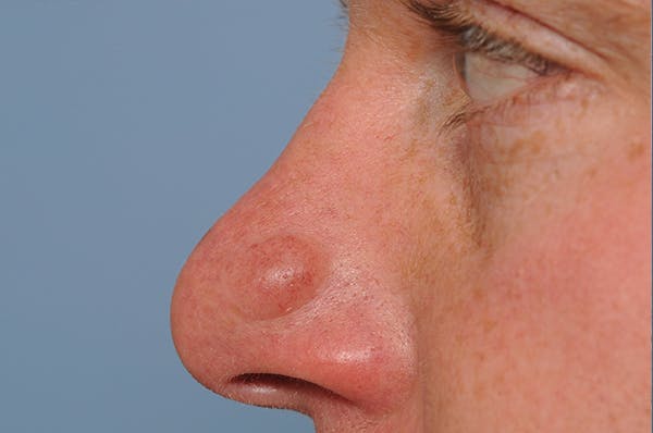 Mole Removal Before & After Gallery - Patient 8647153 - Image 5