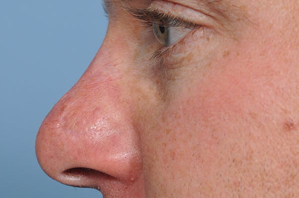 Mole Removal Before & After Gallery - Patient 8647153 - Image 6