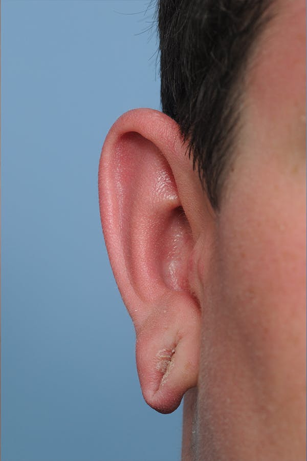 Patient 8647164 Earlobe Repair Before & After Dr. Victoria Givens