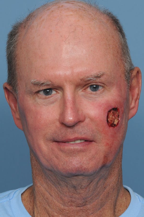 Facial Skin Cancer Reconstruction Gallery - Patient 8647178 - Image 1
