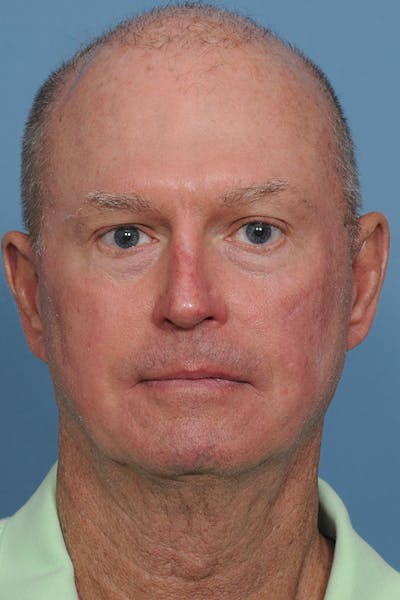 Facial Skin Cancer Reconstruction Gallery - Patient 8647178 - Image 2