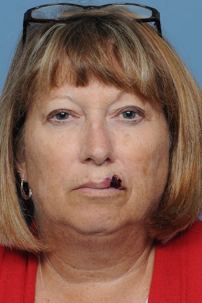 Facial Skin Cancer Reconstruction Gallery - Patient 8647179 - Image 1