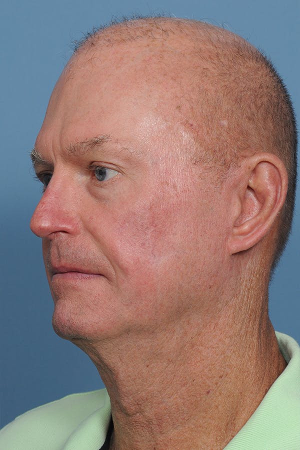 Facial Skin Cancer Reconstruction Gallery - Patient 8647178 - Image 6