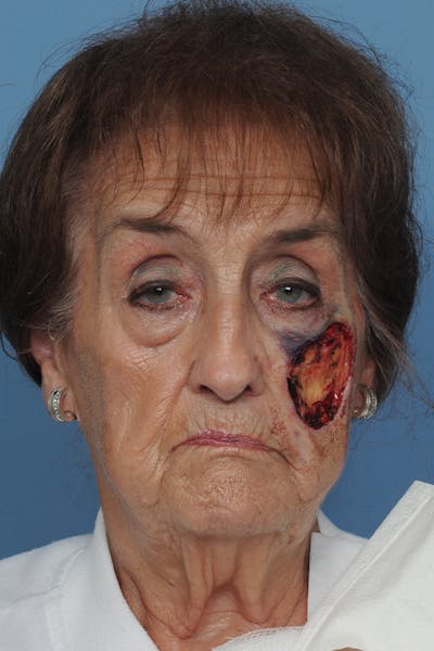 Facial Skin Cancer Reconstruction Gallery - Patient 8647180 - Image 1