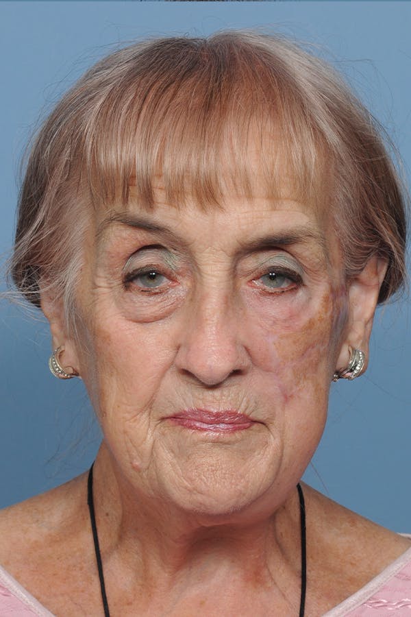 Facial Skin Cancer Reconstruction Gallery - Patient 8647180 - Image 2