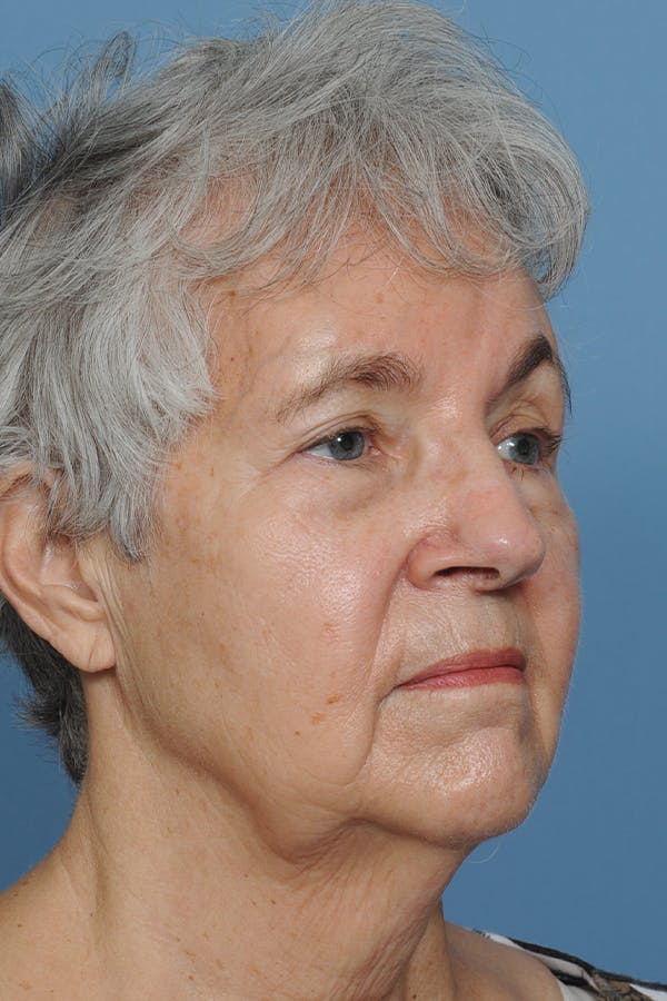 Facial Skin Cancer Reconstruction Gallery - Patient 8647177 - Image 10
