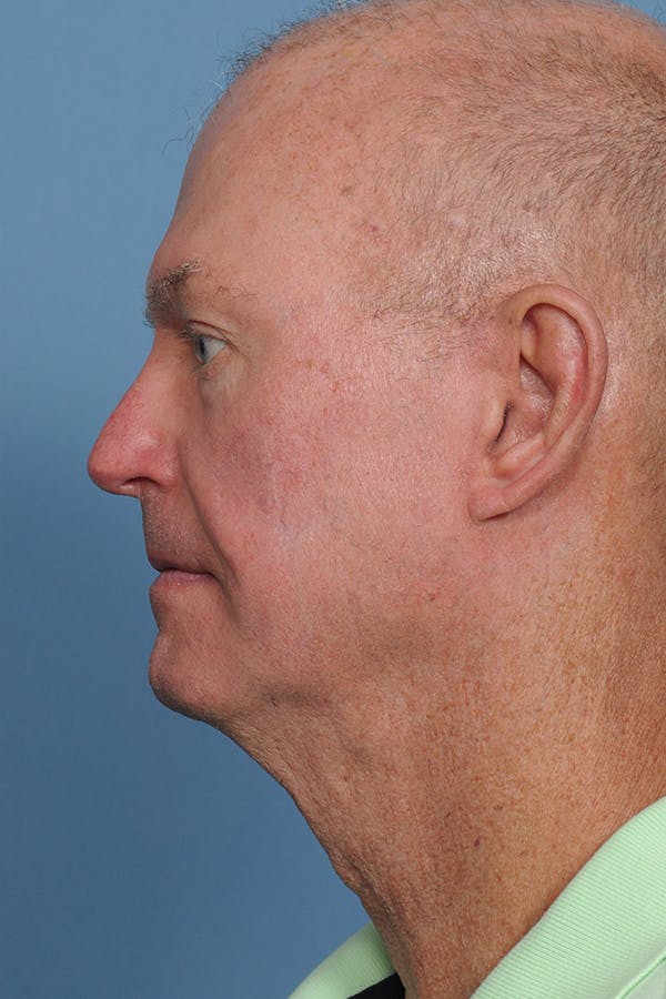 Facial Skin Cancer Reconstruction Gallery - Patient 8647178 - Image 4