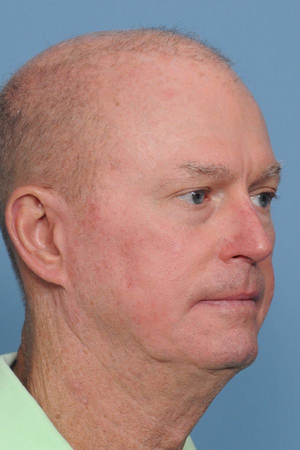 Facial Skin Cancer Reconstruction Gallery - Patient 8647178 - Image 10