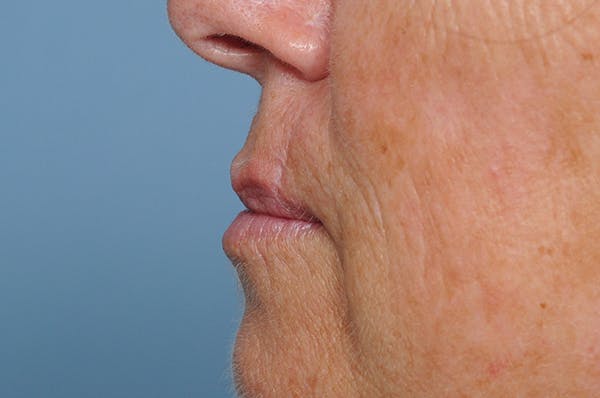 Facial Skin Cancer Reconstruction Gallery - Patient 8647179 - Image 6