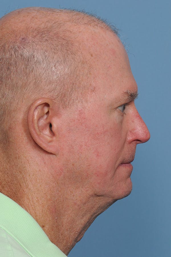 Facial Skin Cancer Reconstruction Gallery - Patient 8647178 - Image 8