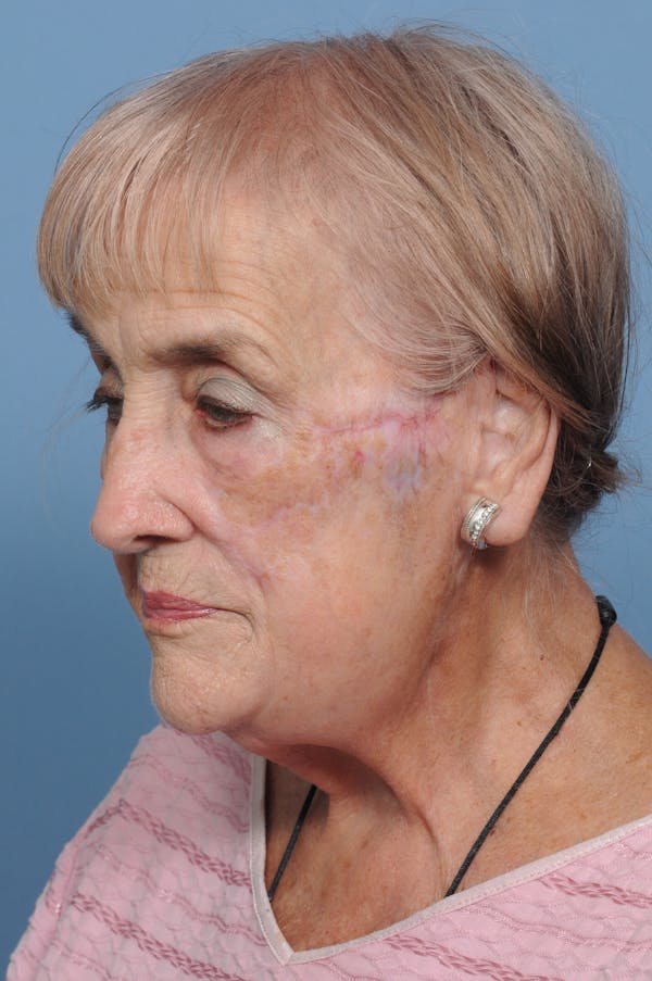 Facial Skin Cancer Reconstruction Gallery - Patient 8647180 - Image 6