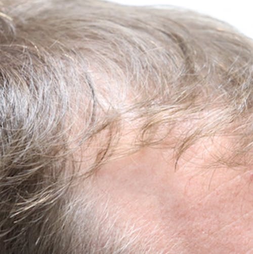 Before and after Hair Restoration with Exosomes in Austin