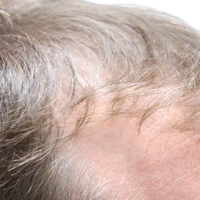 Hair Restoration with Exosomes Before & After Gallery - Patient 21033294 - Image 1