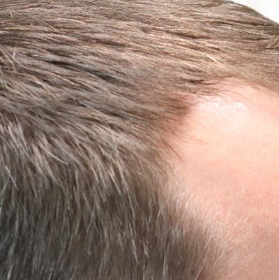 Hair Restoration with Exosomes Before & After Gallery - Patient 21033294 - Image 2